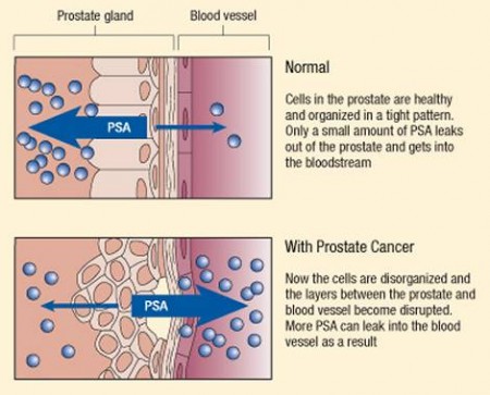 Prostate specific antigen released into bloodstream during cancer