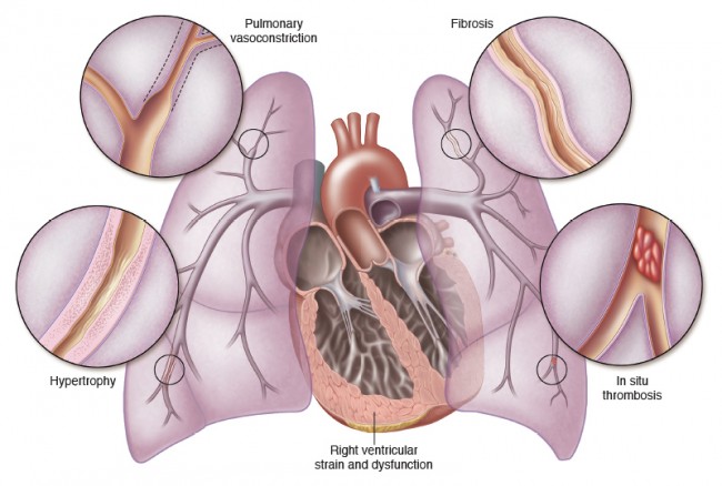 Hypertension, pulmonary; Pulmonary Hypertension