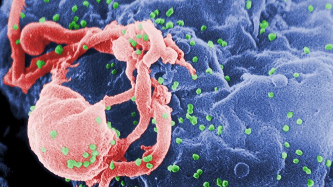 New virulent HIV strain leads to AIDS within five years
