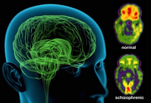 International team sheds new light on biology underlying schizophrenia