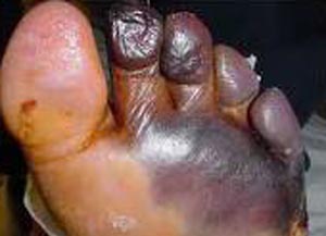 diabetic foot