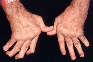 rheumatoid arthritis hands