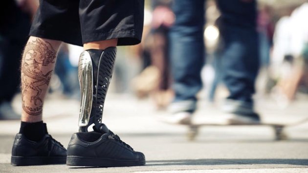 Orthopedic company took off external prostheses of patient that couldn't pay