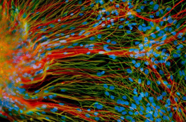 Unique Stem Cell Therapy for MS Patients