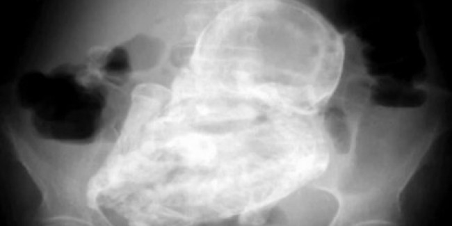 44-Year-Old Fetus Still Inside 84-Year-Old Woman Fetus, 84, 44, lithopedion, stone baby