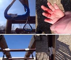 Razor Blades Glued to Playground Equipment Injure Toddler