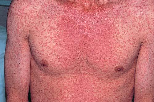 Measles Outbreak Confirmed in NYC Area · Guardian Liberty Voice