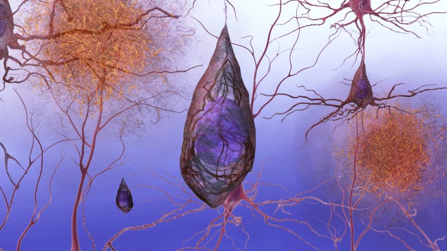 alzheimer's disease prevention alzheimer 