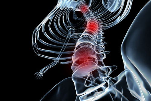 spinal cord injury