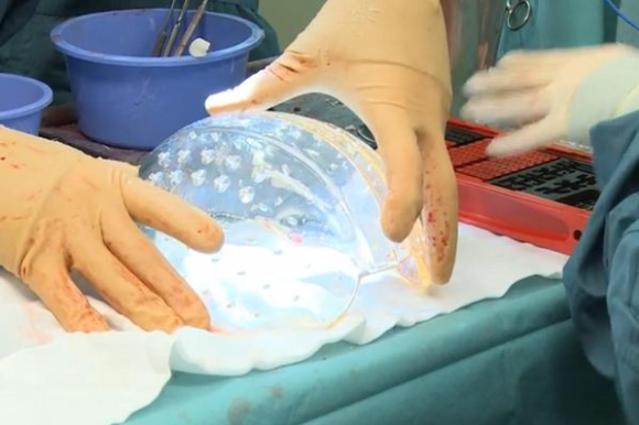 Woman Has Plastic Transparent Skull Embedded Inside Her Head [Video]