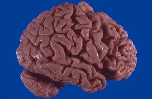 Brain Brain Can Literally Shrink, Study Finds