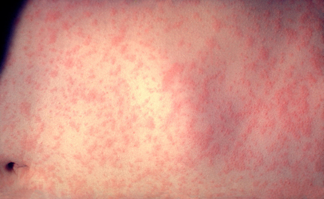 Measles Cases Around US Spark Concerns of a Comeback measles