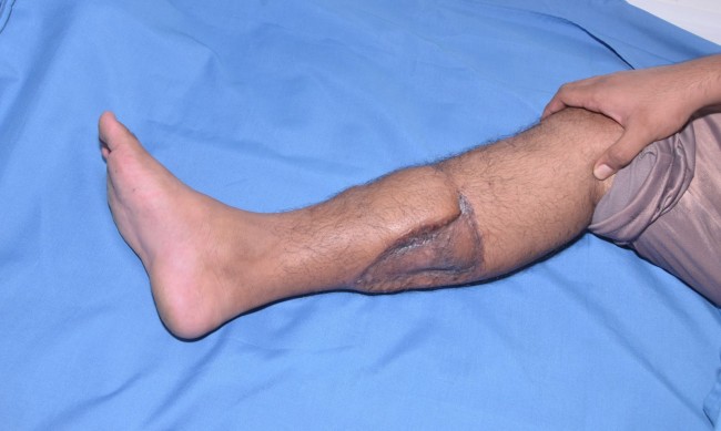 Skin Grafts Heisted Skin