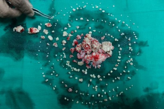 232 Teeth Removed From Mouth of Teenager 1 232 Teeth Removed From Mouth of Teenager