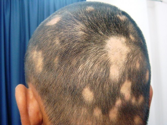 alopecia