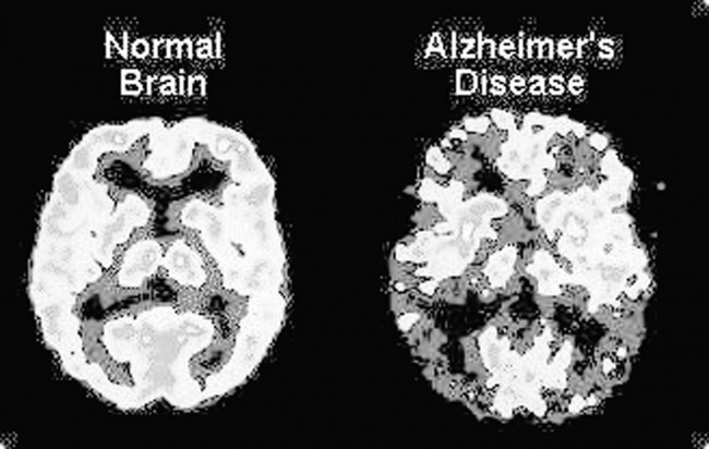 Alzheimer's Disease Breakthrough Developments Alzheimer's