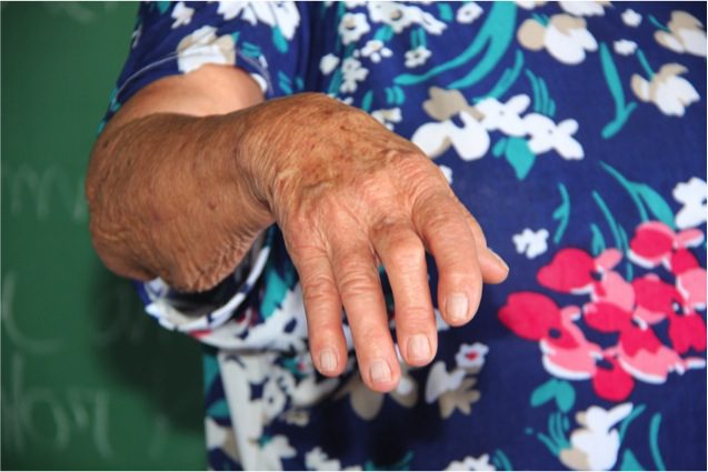 Rheumatoid Arthritis