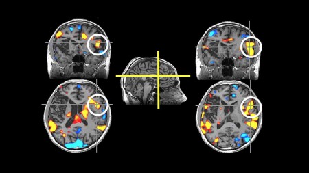 stroke victims