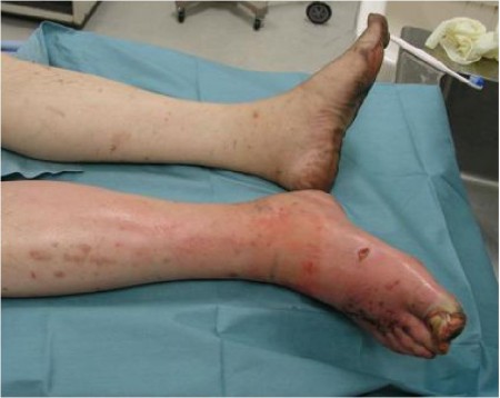 Necrotizing Fasciitis: 10 Things to Know About Flesh-Eating Bacteria Necrotizing Fasciitis