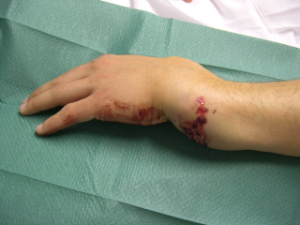 Pain Management Bone Fractures