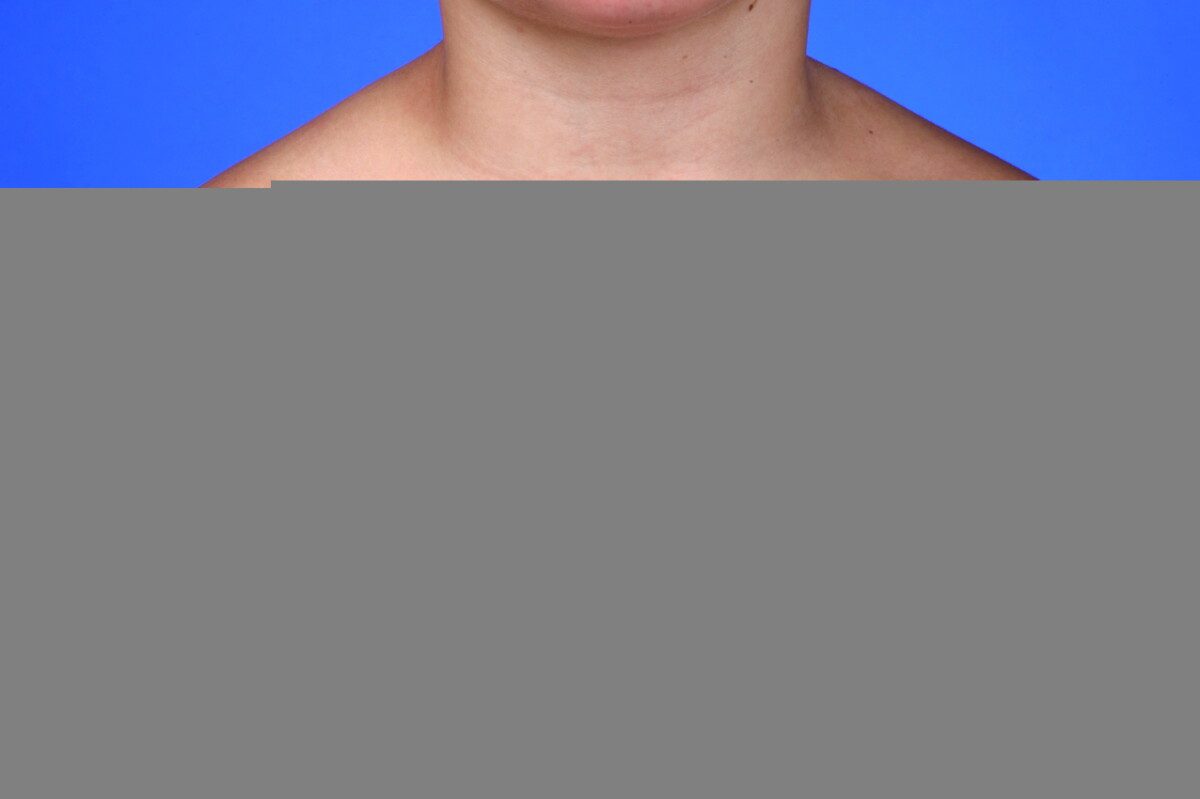 Juvenile Dermatomyositis