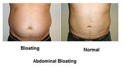 distended abdomen symptoms