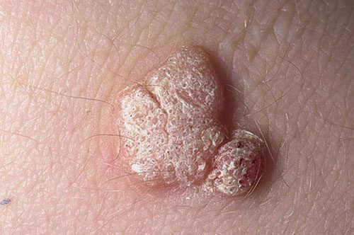 genital-warts-removal-home-remedy-youtube