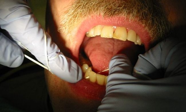 Dental Floss Oral Hygiene Hoax? Dental Floss