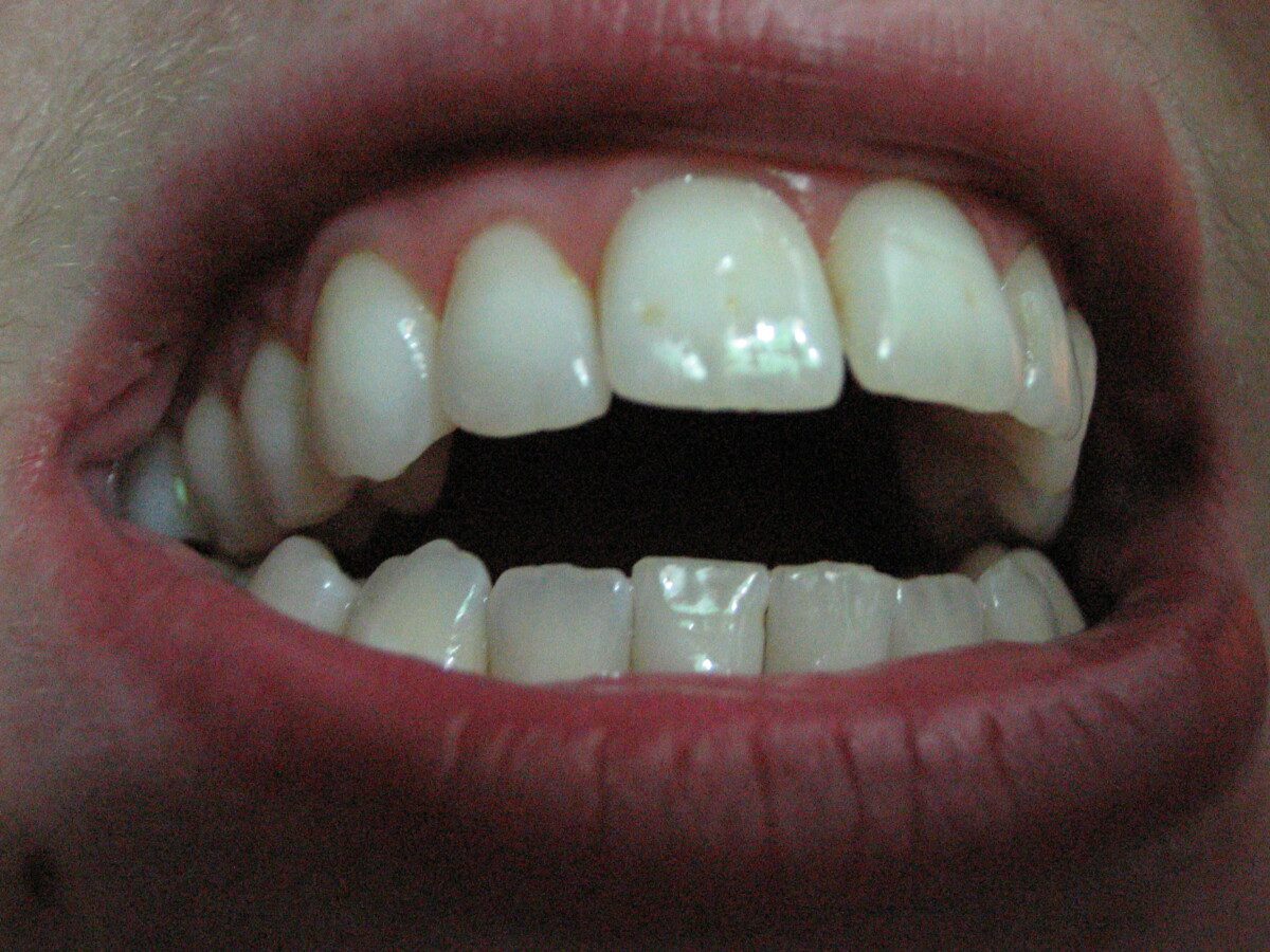 Коричневая эмаль зубов