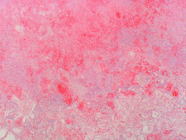 Herpes Kills Two Mothers in the UK herpes