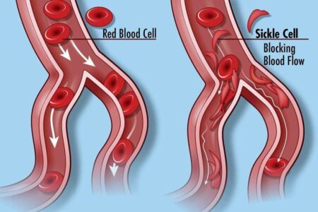 Gene-Editing Recipient of Sickle Cell Treatment Continues to Thrive sickle cell