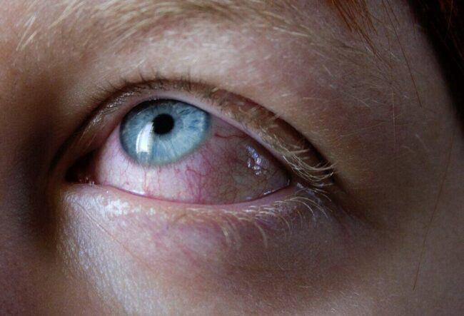 Multisystem Inflammatory Syndrome