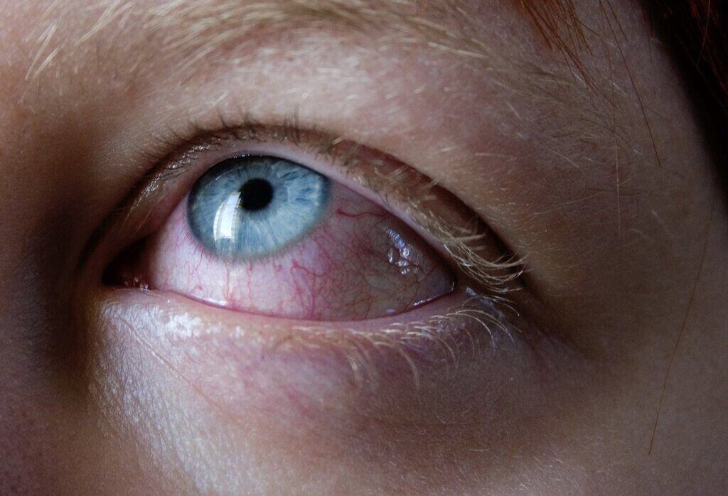 Multisystem Inflammatory Syndrome