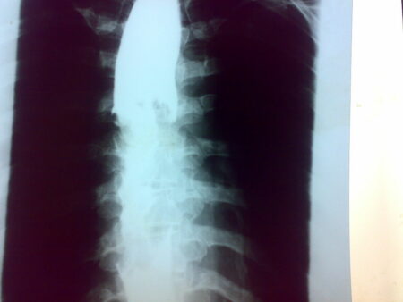 Esophageal Cancer on the Rise Among Middle-Aged Americans Esophageal Cancer