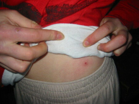 Powassan Virus First Case Reported in Connecticut Powassan