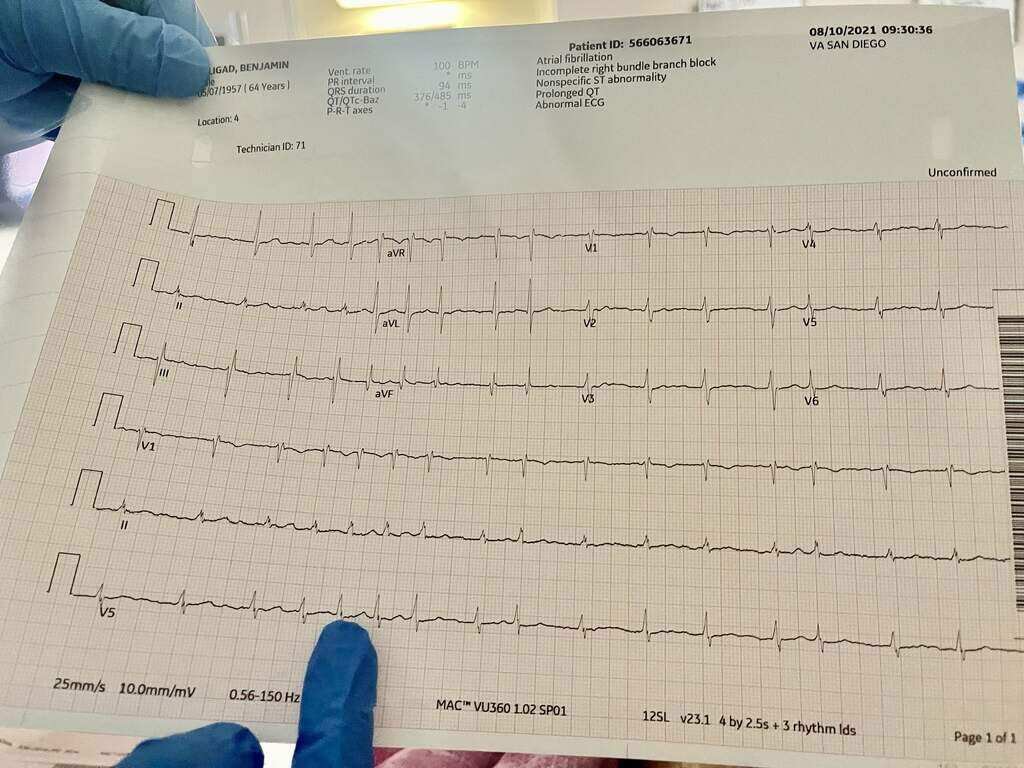 Atrial Fibrillation