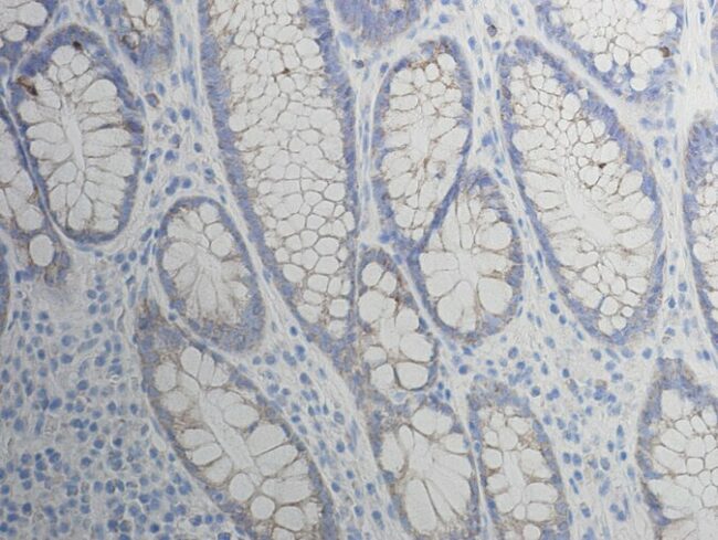 Trial of a New Cancer Drug Experiences 100% Remission cancer