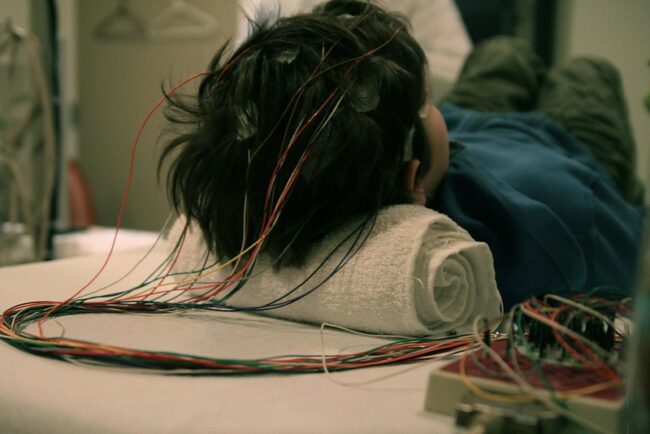 Epilepsy Affects Millions of People Epilepsy