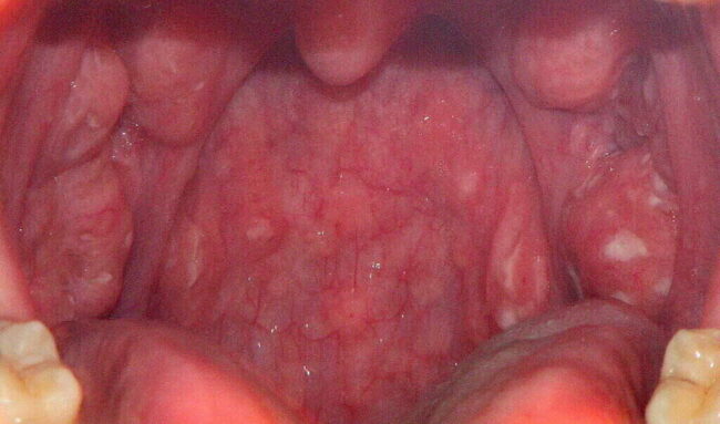 strep throat